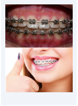 Conventional Braces Berwick - Woodleigh Waters Dental Surgery